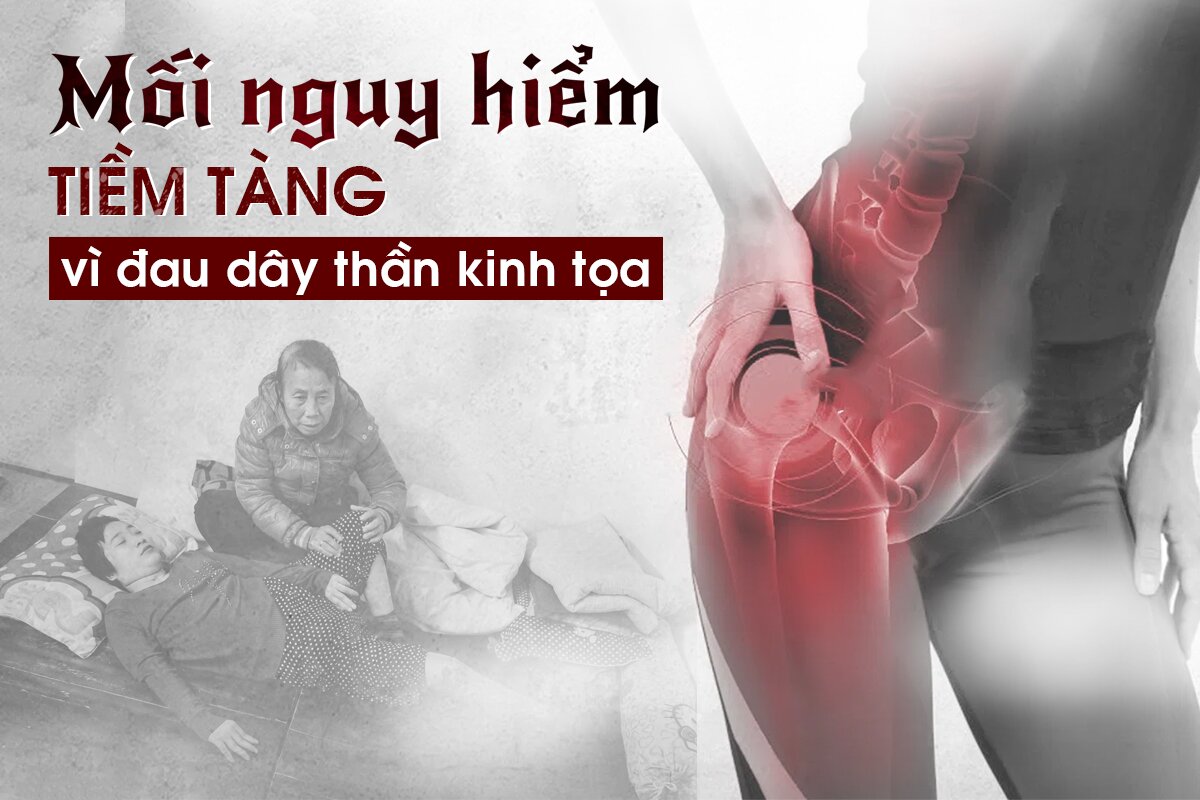 Giải thoát những BIẾN CHỨNG của đau thần kinh tọa NHỜ AN CỐT NAM